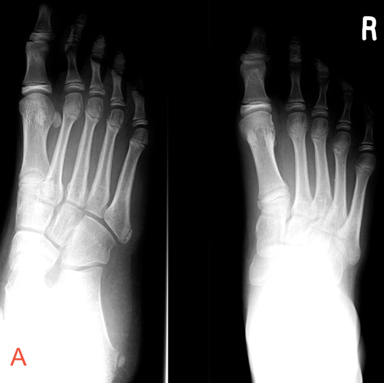 Figure 2 for case Fifth metatarsal base injuries